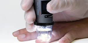 molescope